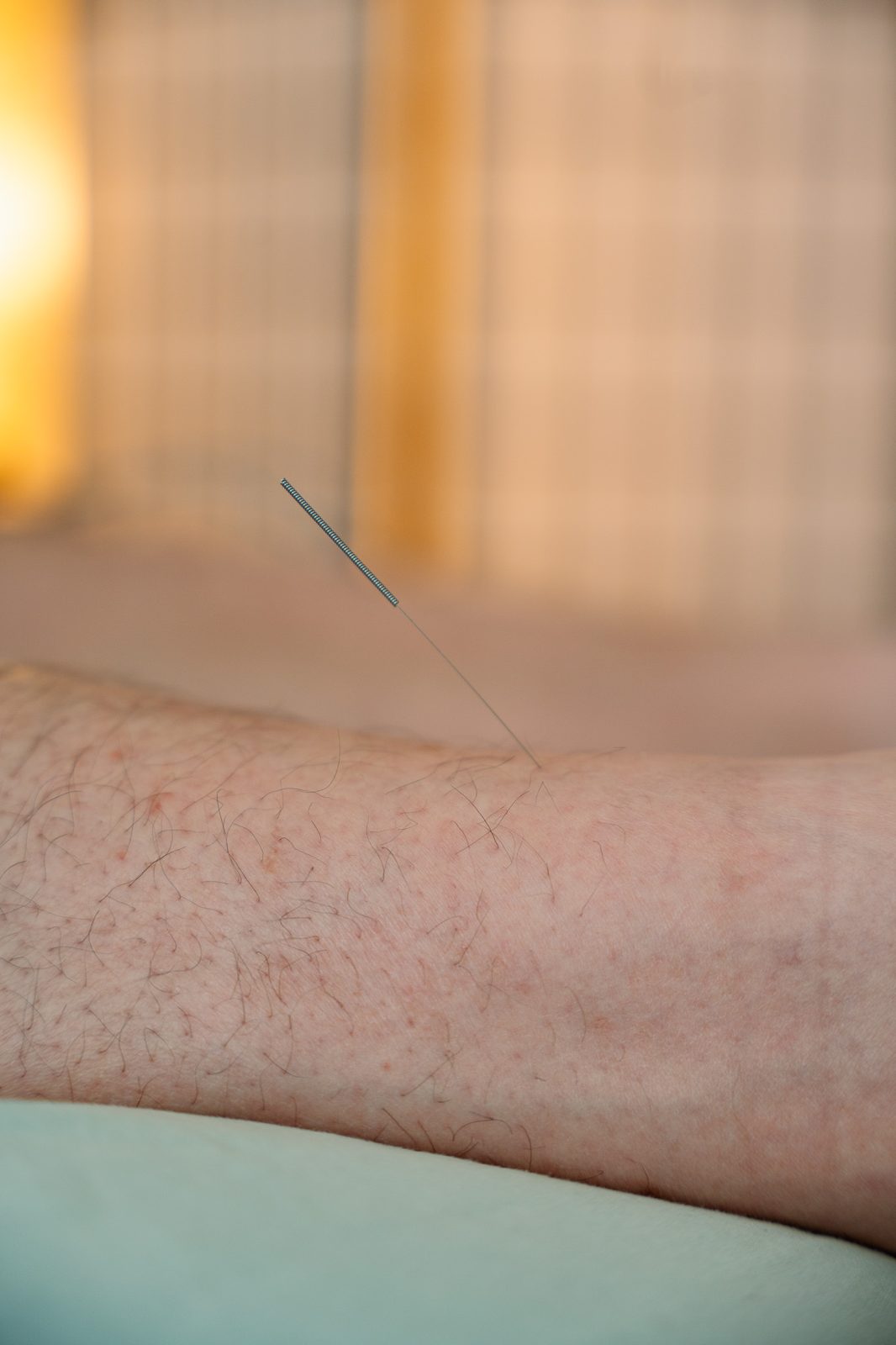 Acupuncture and Dermatology: Enhancing Skin Health Naturally